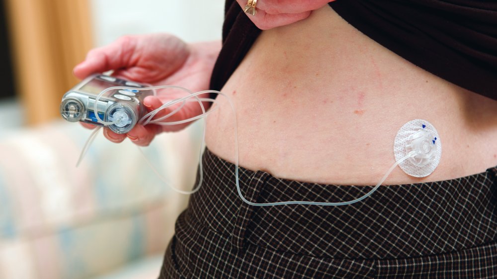 Tubed insulin pump installed for use
