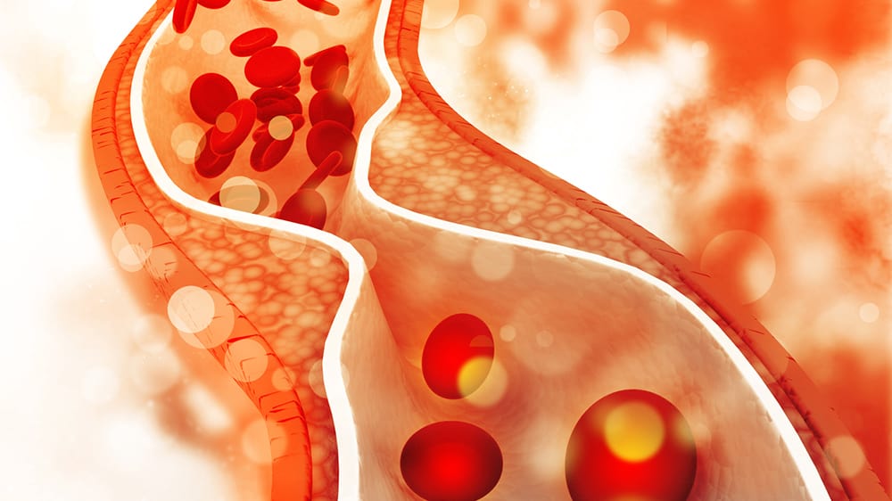 controlling your cholesterol, plaque in arteries